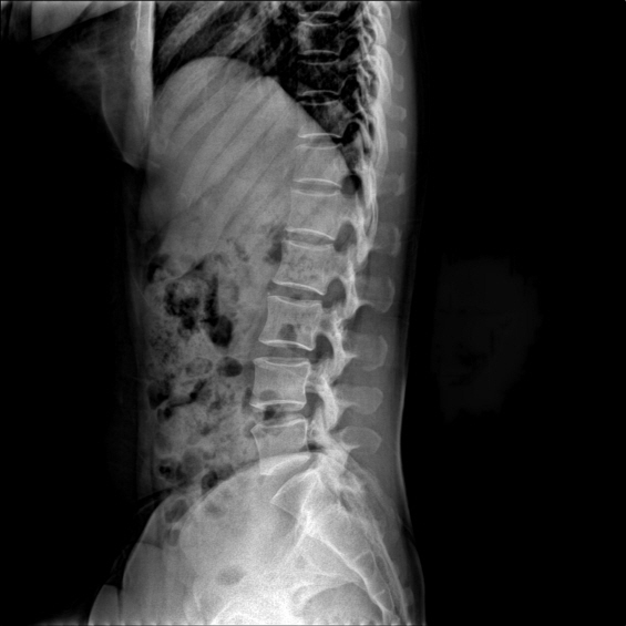 L-SPINE LAT1.jpg